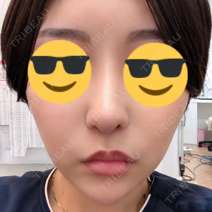 隆鼻術 / 軟骨移植 / 骨切幅寄せ / 鼻尖縮小 / その他（鼻） 韓国BBクリニック（旧 シンミアン形成外科） DAY 104 メイン用