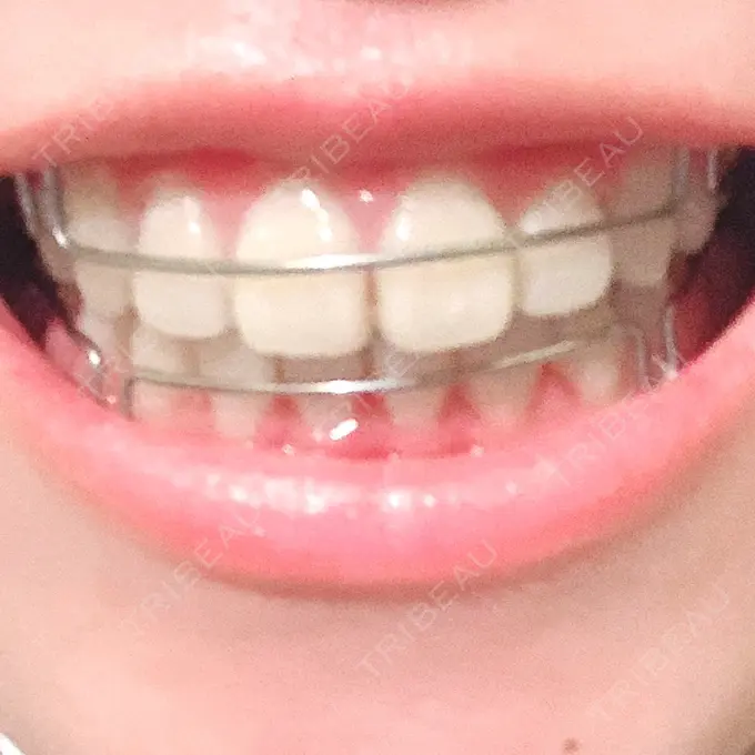 矯正（ワイヤー） ランバート矯正歯科 AFTER メイン用