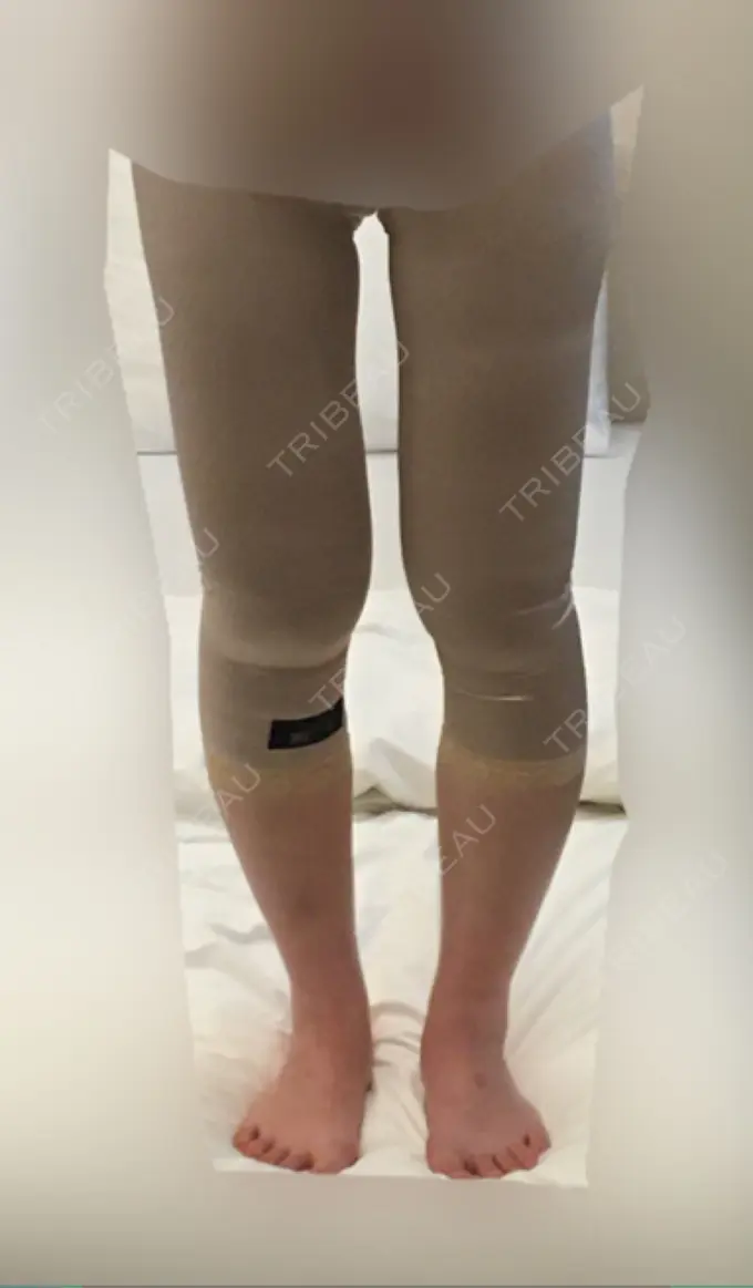 脂肪吸引（脚） / 脂肪吸引（お尻） ドクターフィット（Dr.fit）クリニック DAY 1 メイン用