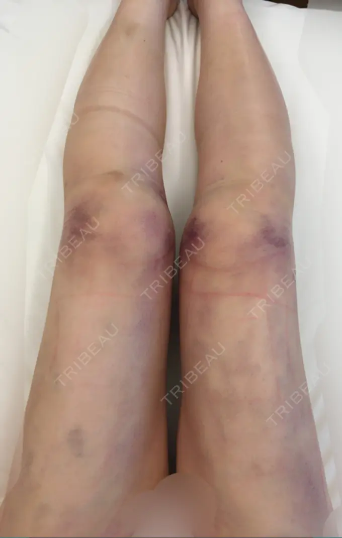 脂肪吸引（脚） / 脂肪吸引（お尻） ドクターフィット（Dr.fit）クリニック DAY 2 メイン用