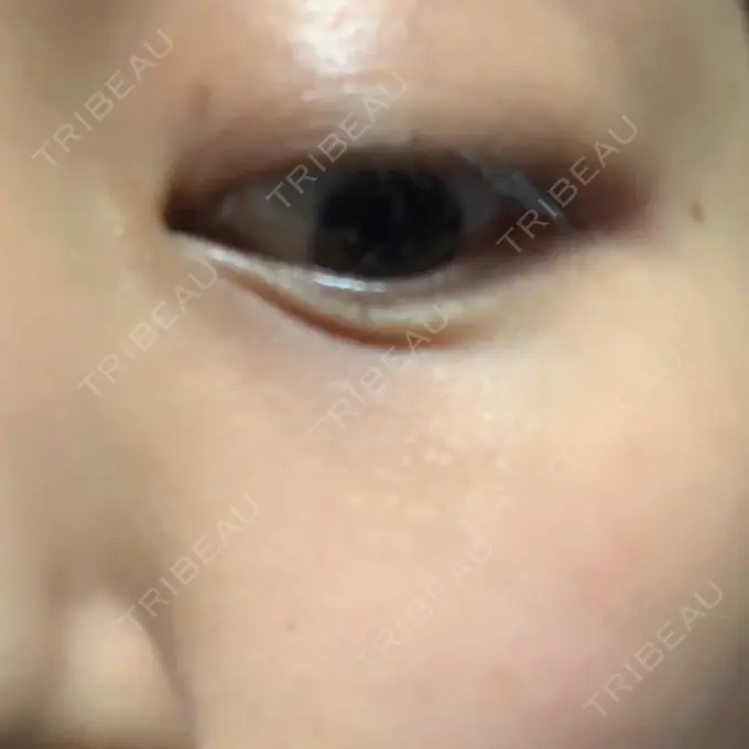 ヒアルロン酸溶解 湘南美容クリニック 大阪京橋院 DAY 2 メイン用