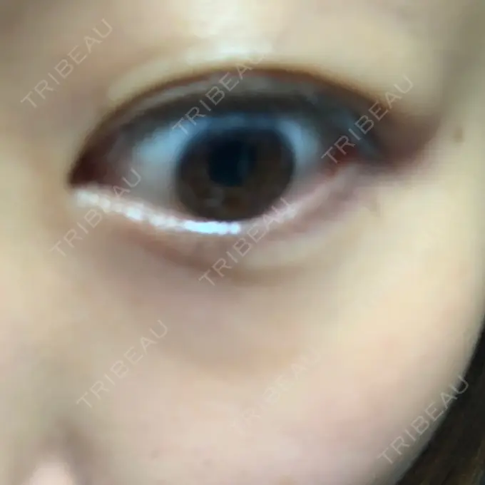 ヒアルロン酸溶解 湘南美容クリニック 大阪京橋院 DAY 2 メイン用