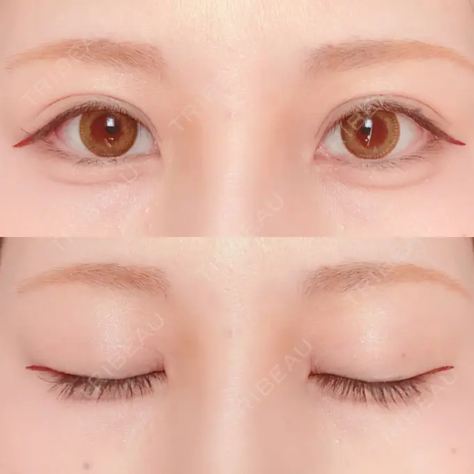 二重切開 / 上まぶたの脂肪取り / その他（目元） 銀座高須クリニック DAY 147 メイン用