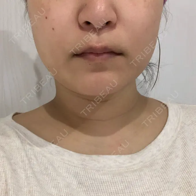 糸リフト / 脂肪溶解注射（顔） 品川スキンクリニック 新潟院 DAY 11 メイン用