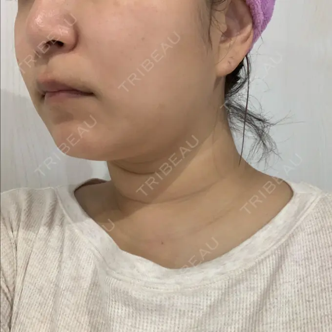 糸リフト / 脂肪溶解注射（顔） 品川スキンクリニック 新潟院 DAY 11 メイン用