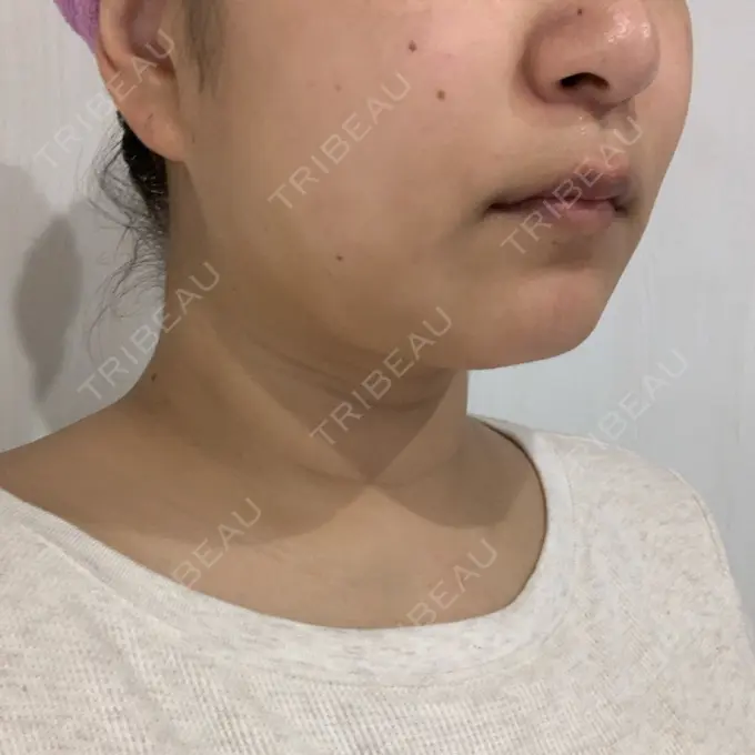 糸リフト / 脂肪溶解注射（顔） 品川スキンクリニック 新潟院 DAY 11 メイン用