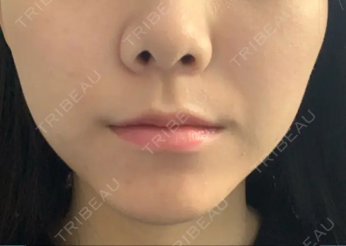 ボトックス（エラ・小顔） / 脂肪溶解注射（顔） ビクアスクリニック AFTER メイン用