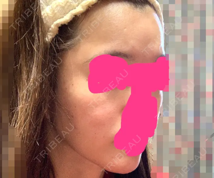 こめかみ形成 / ヒアルロン酸注入（額） / ヒアルロン酸注入（頬） ジョウクリニック 大阪院 DAY 1 メイン用