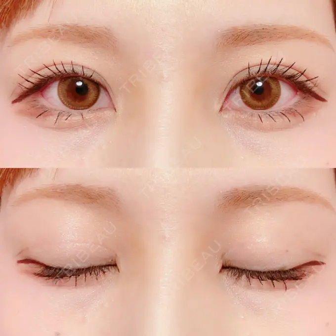 二重切開 / 上まぶたの脂肪取り / その他（目元） 銀座高須クリニック DAY 149 メイン用