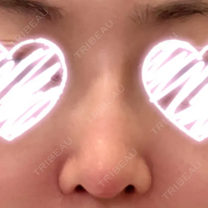 隆鼻術 / 軟骨移植 みずほクリニック DAY 45 メイン用