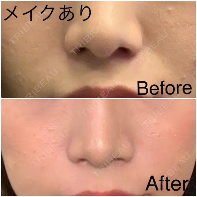 肌ヒアルロン酸注入（たるみ・シワ改善） / その他（肌） フィラークリニック 新宿院 DAY 1 メイン用