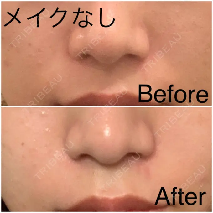 肌ヒアルロン酸注入（たるみ・シワ改善） / その他（肌） フィラークリニック 新宿院 DAY 1 メイン用