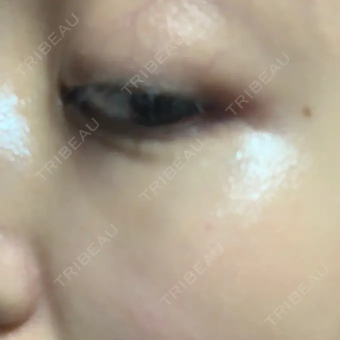 ヒアルロン酸溶解 湘南美容クリニック 大阪京橋院 DAY 5 メイン用