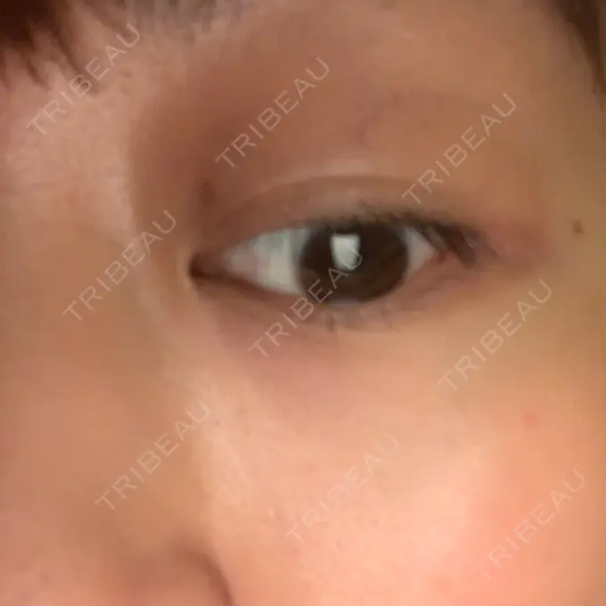 ヒアルロン酸溶解 湘南美容クリニック 大阪京橋院 AFTER メイン用