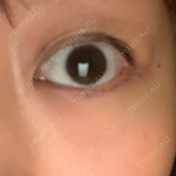 ヒアルロン酸溶解 湘南美容クリニック 大阪京橋院 DAY 6 メイン用