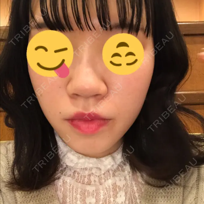 毛穴洗浄（ハイドラフェイシャルなど） 神成（こうせい）美容外科 DAY 2 メイン用