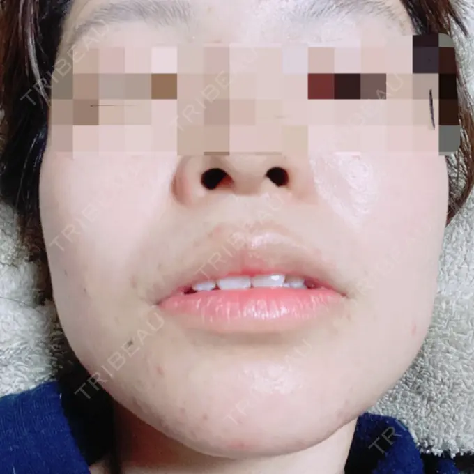 その他（目元） 青山セレスクリニック 青山院 DAY 62 メイン用