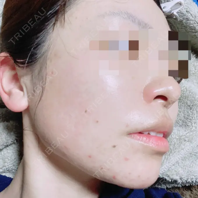 その他（目元） 青山セレスクリニック 青山院 DAY 62 メイン用