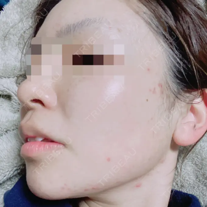 その他（目元） 青山セレスクリニック 青山院 DAY 62 メイン用