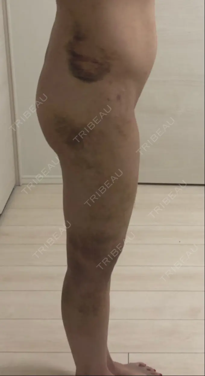 脂肪吸引（脚） / 脂肪吸引（お尻） / その他（ボディ） ドクターフィット（Dr.fit）クリニック DAY 10 メイン用