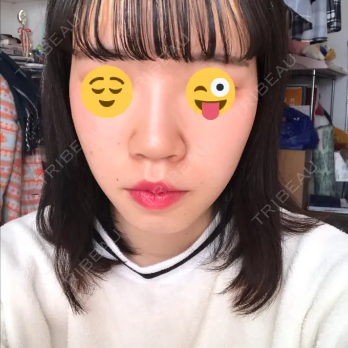 毛穴洗浄（ハイドラフェイシャルなど） 神成（こうせい）美容外科 DAY 3 メイン用