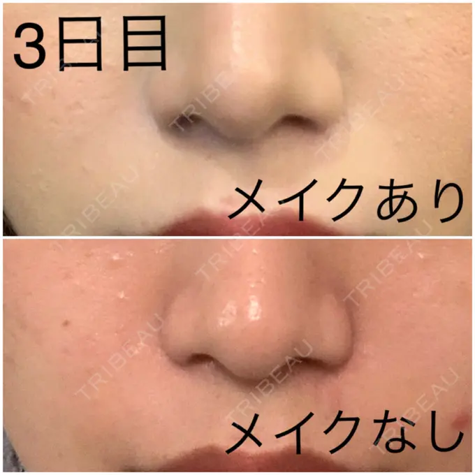 肌ヒアルロン酸注入（たるみ・シワ改善） / その他（肌） フィラークリニック 新宿院 AFTER メイン用