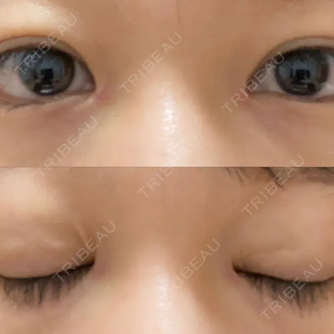 蒙古ひだ形成 / 目元修正 銀座高須クリニック DAY 22 メイン用