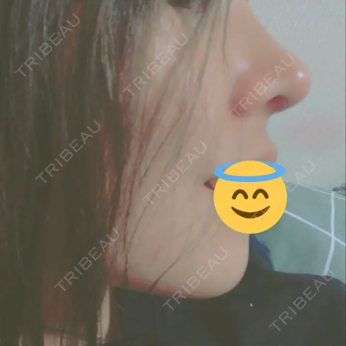 隆鼻術 / 鼻尖形成（切開） / 鼻中隔延長（切開） / 眉間プロテーゼ FROM B整形外科 (旧バウム整形外科) AFTER メイン用