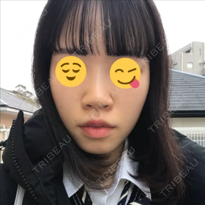 毛穴洗浄（ハイドラフェイシャルなど） 神成（こうせい）美容外科 DAY 4 メイン用