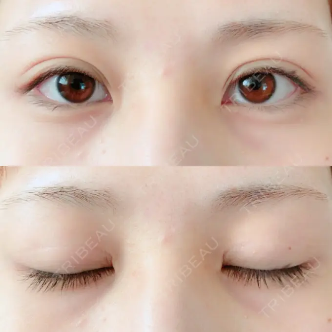 二重切開 / 上まぶたの脂肪取り / その他（目元） 銀座高須クリニック DAY 153 メイン用