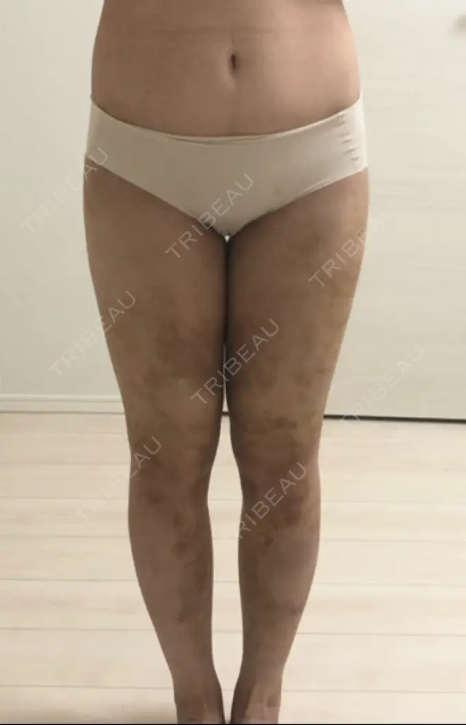 脂肪吸引（脚） / 脂肪吸引（お尻） / その他（ボディ） ドクターフィット（Dr.fit）クリニック DAY 12 メイン用