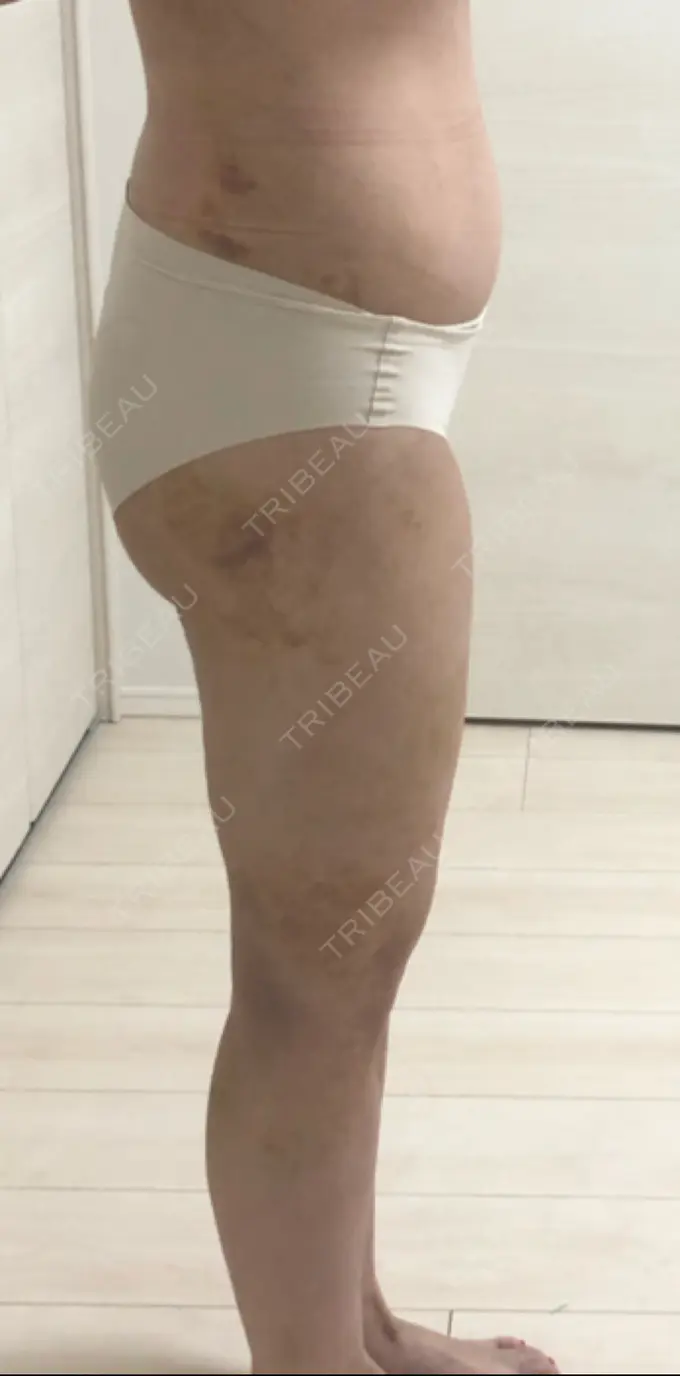 脂肪吸引（脚） / 脂肪吸引（お尻） / その他（ボディ） ドクターフィット（Dr.fit）クリニック DAY 12 メイン用