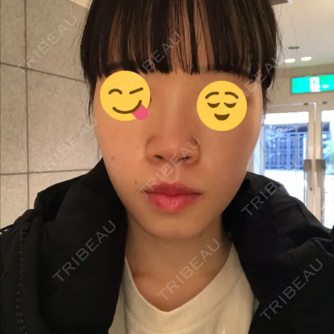 毛穴洗浄（ハイドラフェイシャルなど） 神成（こうせい）美容外科 DAY 5 メイン用