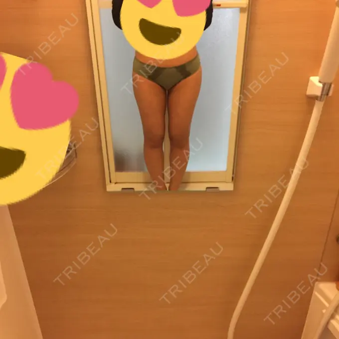 脂肪吸引（脚） / 脂肪吸引（お尻） ヨンセスリムライン DAY 61 メイン用