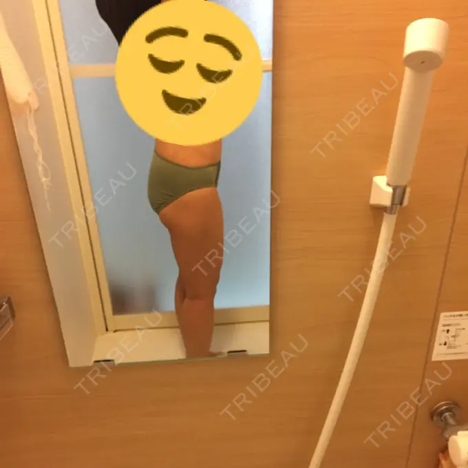 脂肪吸引（脚） / 脂肪吸引（お尻） ヨンセスリムライン DAY 61 メイン用