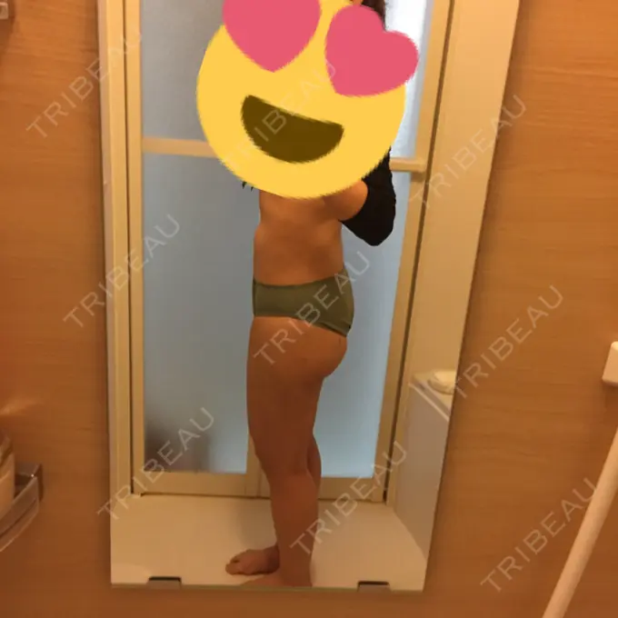 脂肪吸引（脚） / 脂肪吸引（お尻） ヨンセスリムライン DAY 61 メイン用