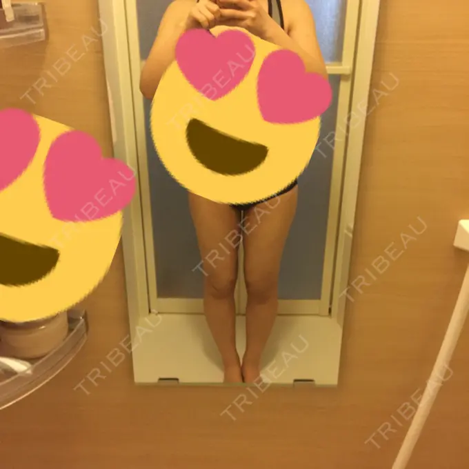 脂肪吸引（脚） / 脂肪吸引（お尻） ヨンセスリムライン AFTER メイン用