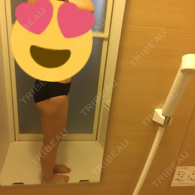 脂肪吸引（脚） / 脂肪吸引（お尻） ヨンセスリムライン DAY 69 メイン用