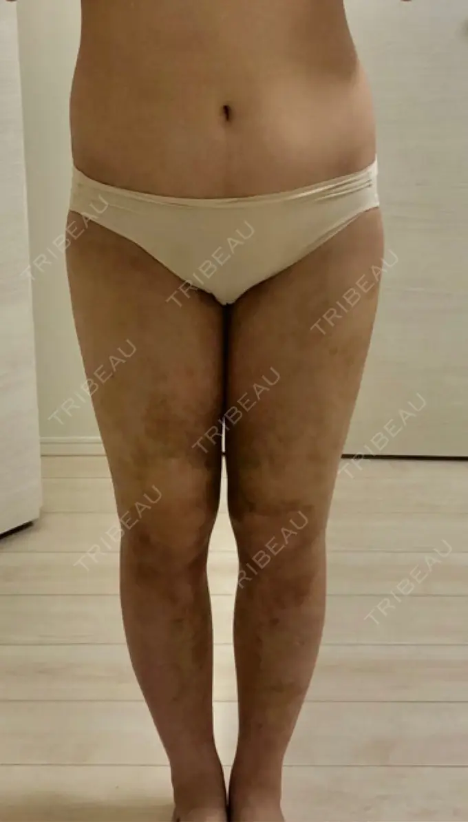 脂肪吸引（脚） / 脂肪吸引（お尻） / その他（ボディ） ドクターフィット（Dr.fit）クリニック AFTER メイン用