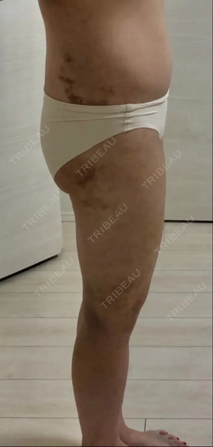 脂肪吸引（脚） / 脂肪吸引（お尻） / その他（ボディ） ドクターフィット（Dr.fit）クリニック DAY 13 メイン用