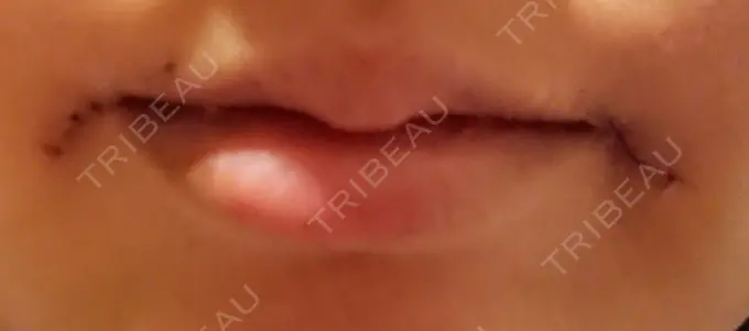 口角挙上 / その他（口元） 現代美学整形外科 DAY 6 メイン用