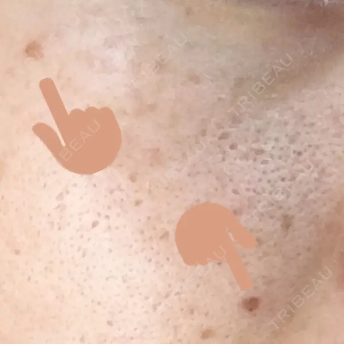 ほくろ・いぼ切除（肌） 金沢中央クリニック AFTER メイン用