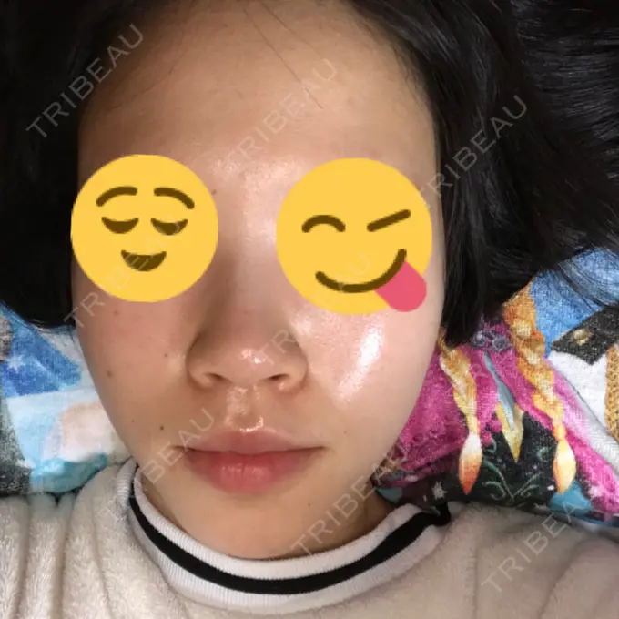 毛穴洗浄（ハイドラフェイシャルなど） 神成（こうせい）美容外科 DAY 7 メイン用