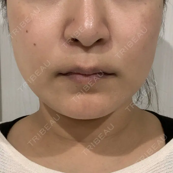 糸リフト / 脂肪溶解注射（顔） 品川スキンクリニック 新潟院 DAY 24 メイン用