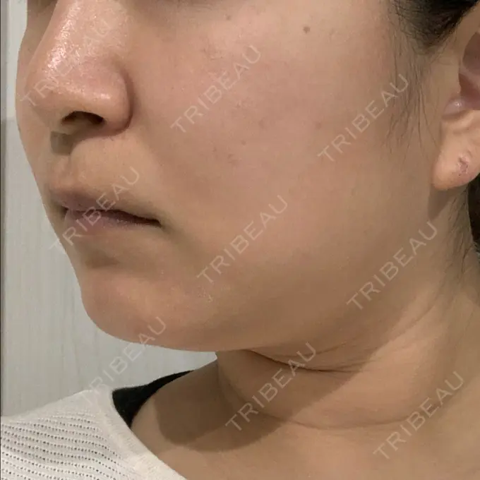 糸リフト / 脂肪溶解注射（顔） 品川スキンクリニック 新潟院 DAY 24 メイン用