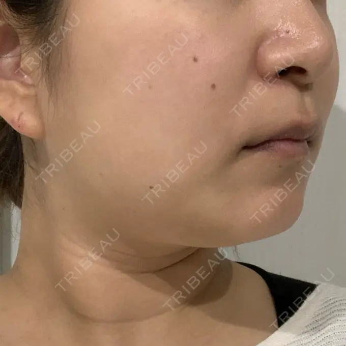 糸リフト / 脂肪溶解注射（顔） 品川スキンクリニック 新潟院 DAY 24 メイン用