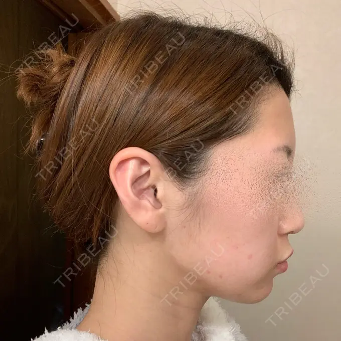 ボトックス（エラ・小顔） / ピーリング（ニキビ・毛穴） 湘南美容クリニック 大阪梅田本院 AFTER メイン用