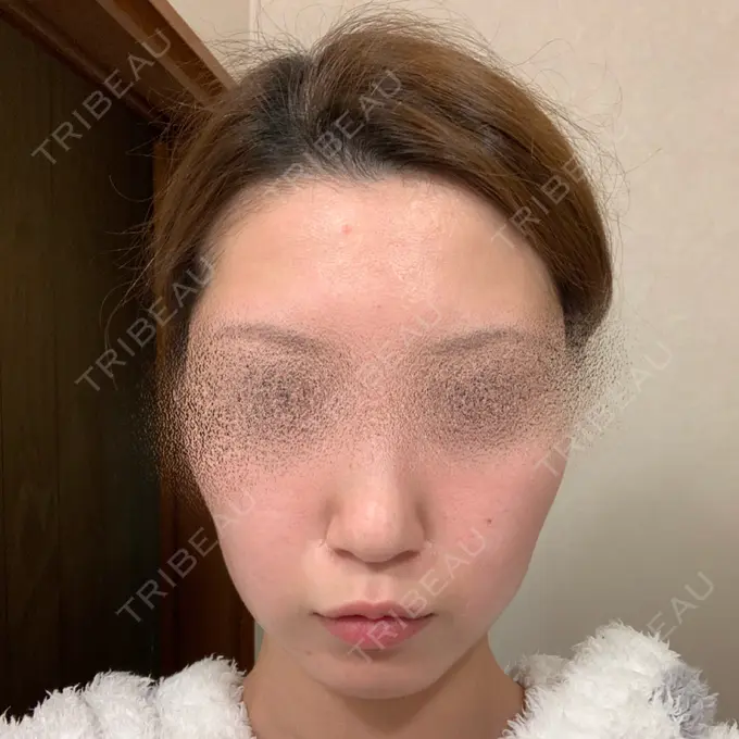 ボトックス（エラ・小顔） / ピーリング（ニキビ・毛穴） 湘南美容クリニック 大阪梅田本院 DAY 90 メイン用