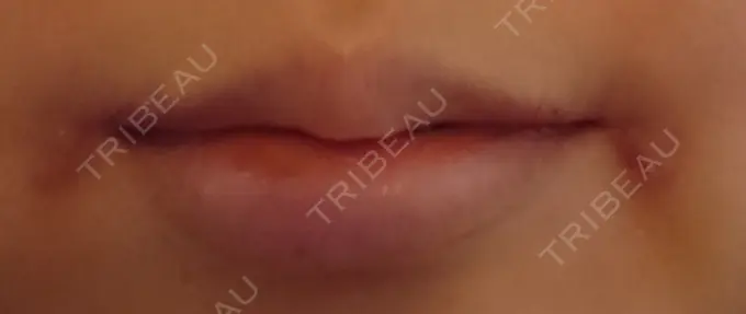 口角挙上 / その他（口元） 現代美学整形外科 DAY 8 メイン用