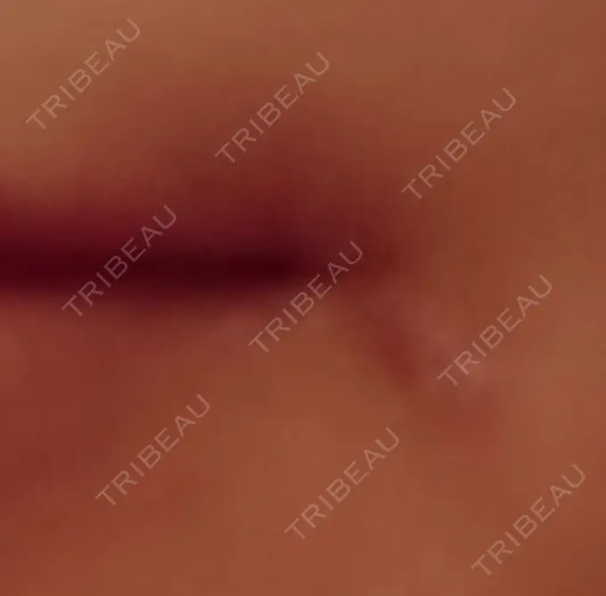 口角挙上 / その他（口元） 現代美学整形外科 DAY 8 メイン用